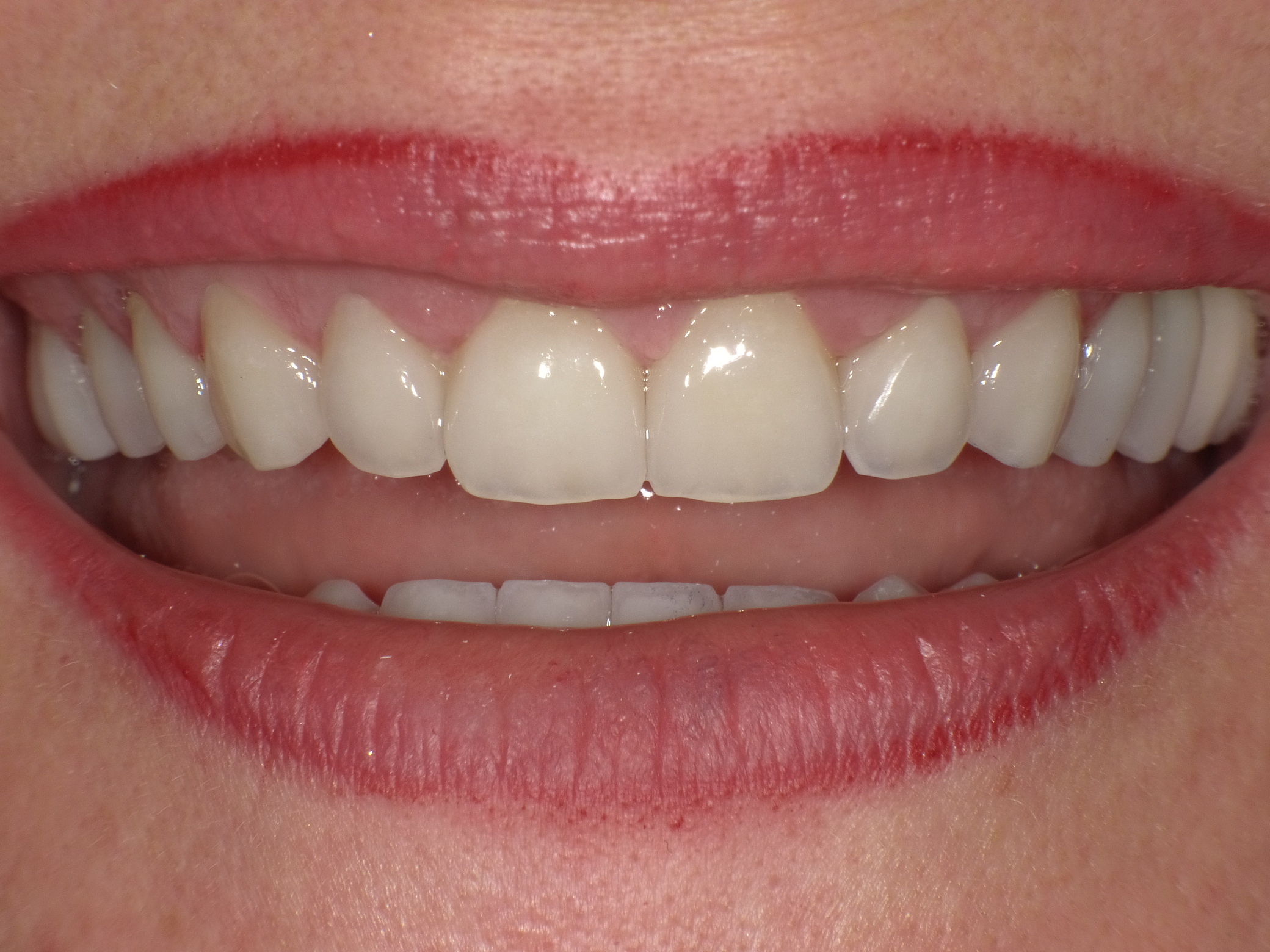 Ergebnis nach nur 2 Langzeit-Behandlungsterminen mit vollkeramischen Veneers und Kronen